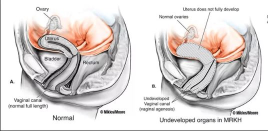 Sindrome Di Mayer Rokitansky Kuster Hauser Di Cosa Si Tratta Maternita It